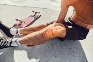 Can Sports Injuries Lead to Hidden Bone Fractures?